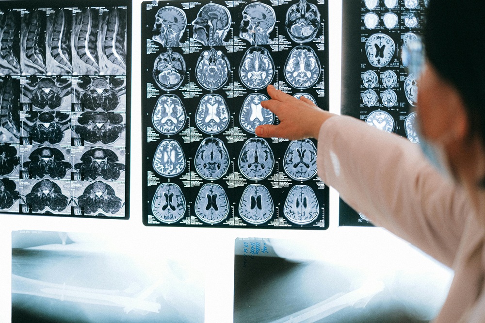 AI tool could revolutionise epilepsy diagnosis
